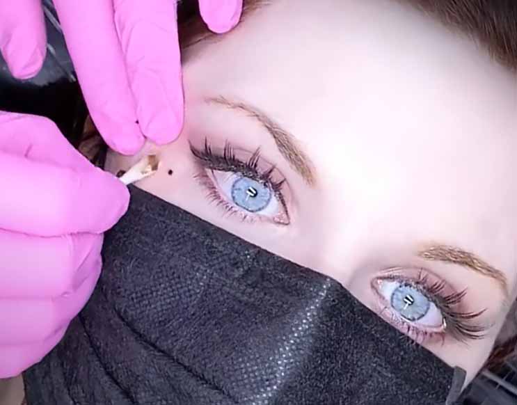 alunita micropigmentata sub ochi
